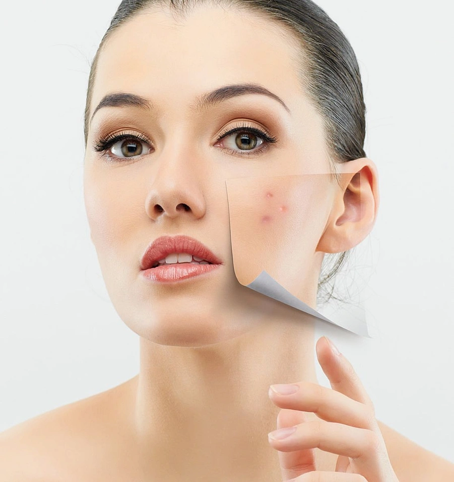 Effective acne removal solutions at ATOS Medical Center