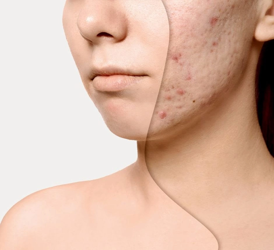 Transformative results from acne scar treatment.