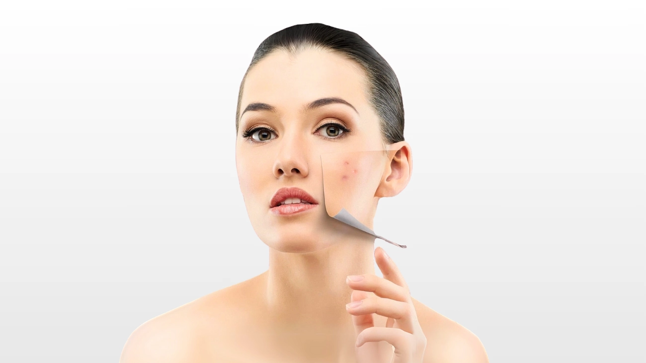 Cheek acne treatment at ATOS Medical Center