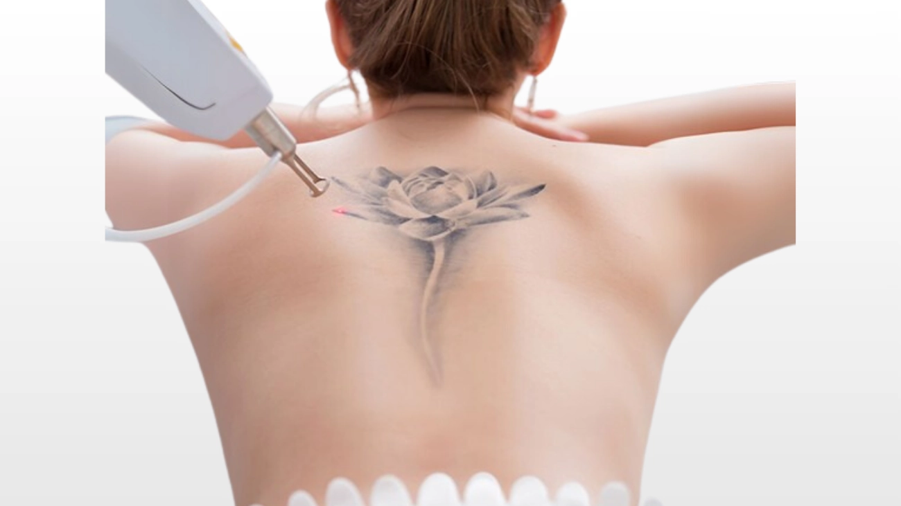 Chest and Back Tattoo Removal in Doha