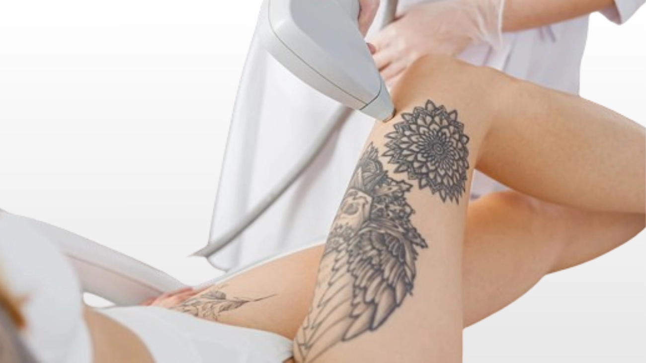 Leg and Thigh Tattoo Removal Procedure Image