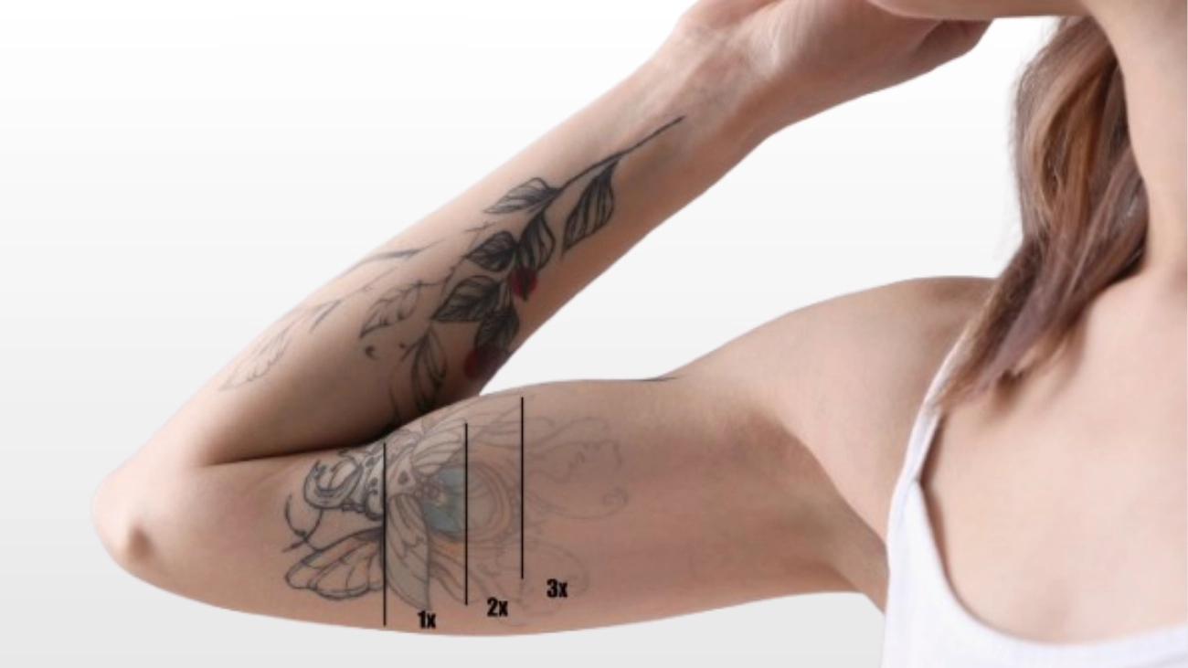 Regret-Free Tattoo Removal service at ATOS Medical Center