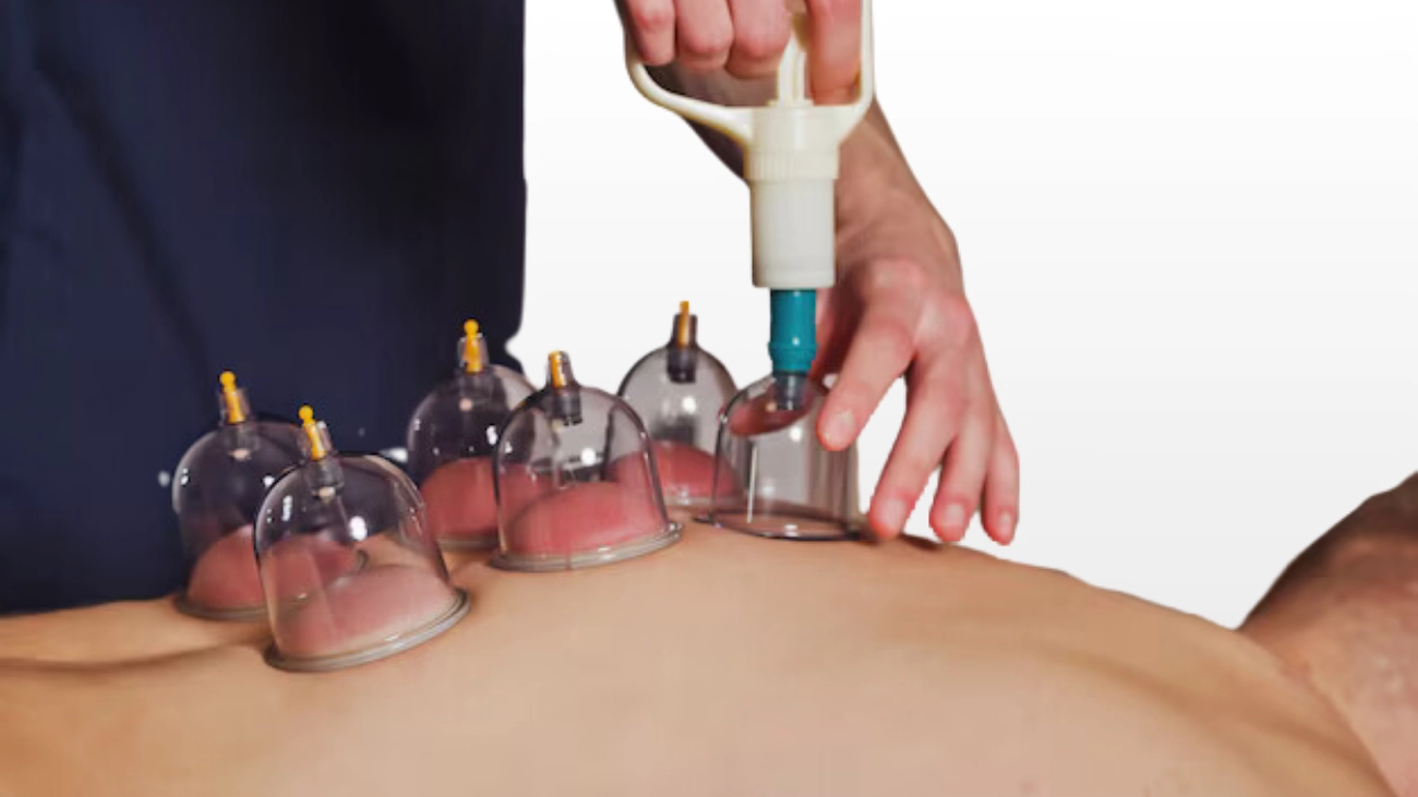 Cupping Therapy session at ATOS Medical Center