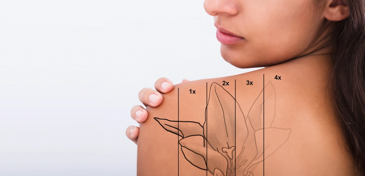 Professional Chest and Back Tattoo Removal Procedure