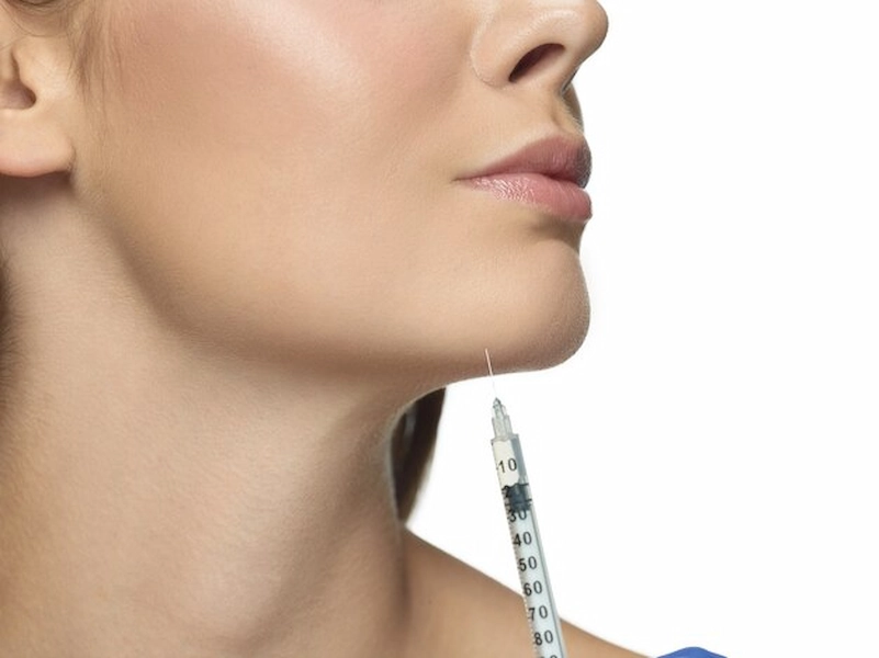 Chin filler procedure for improved profile definition