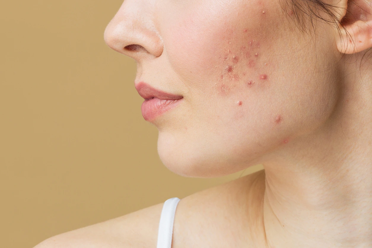 Cheek acne treatment at ATOS Medical Center