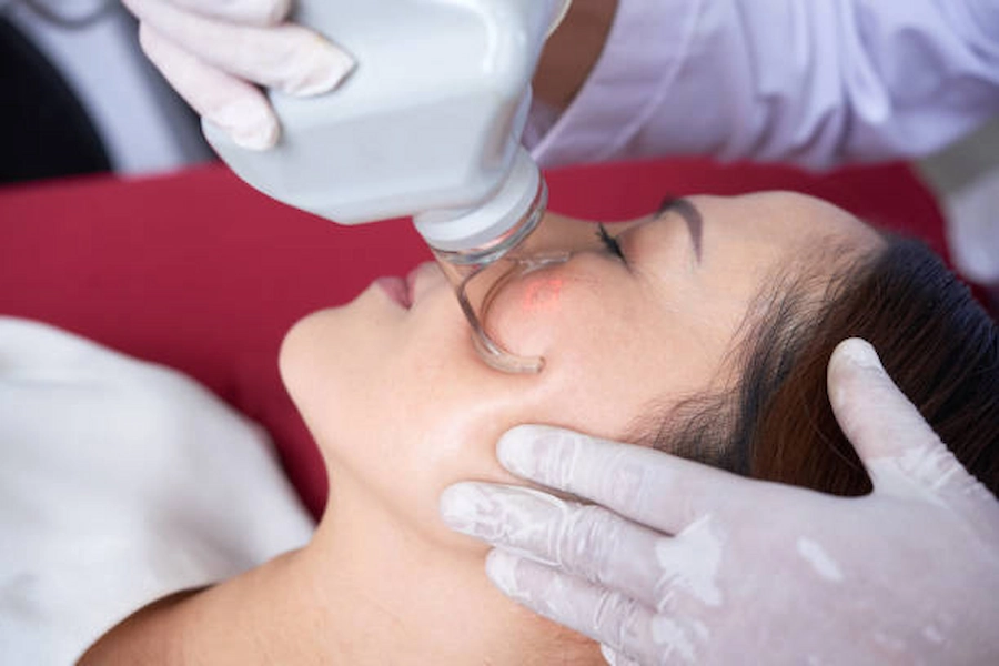 Patient receiving laser treatment for acne scars.