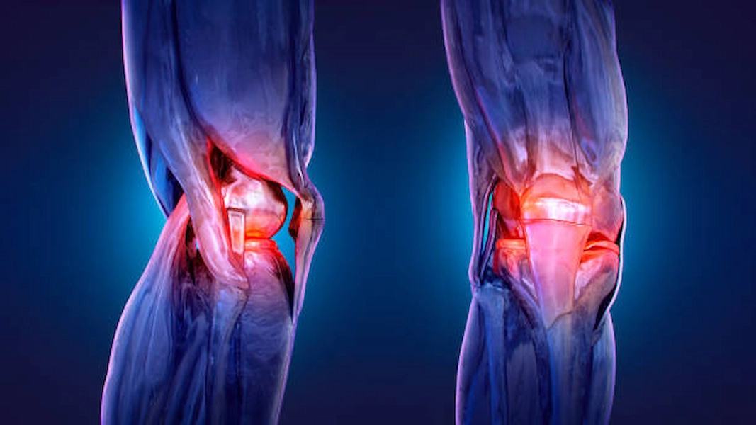 Healing journey for tibia injury recovery.