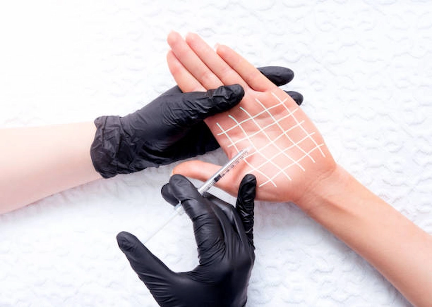 Botox treatment for hyperhidrosis hands in Doha