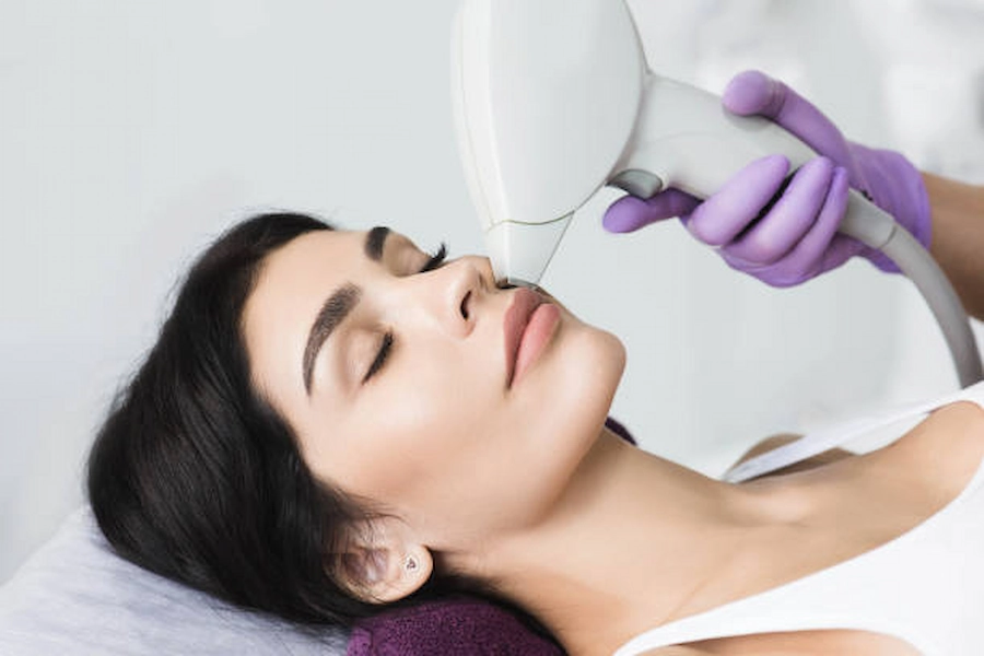 Gentle upper lip laser hair removal session