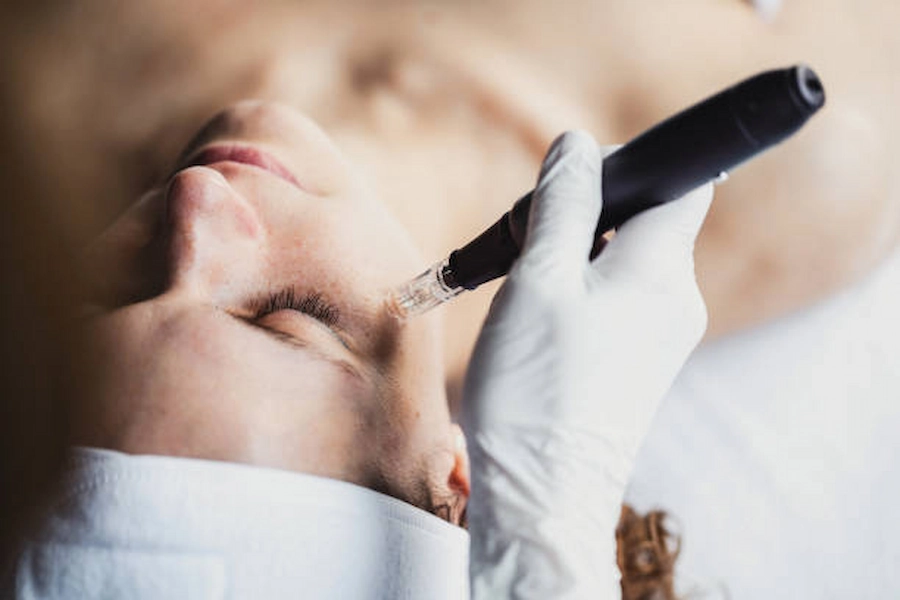 Professional Skin Tag Removal Consultation Image