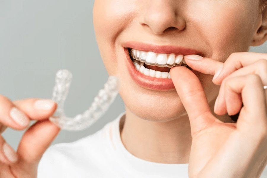 Clear retainers for optimal dental alignment