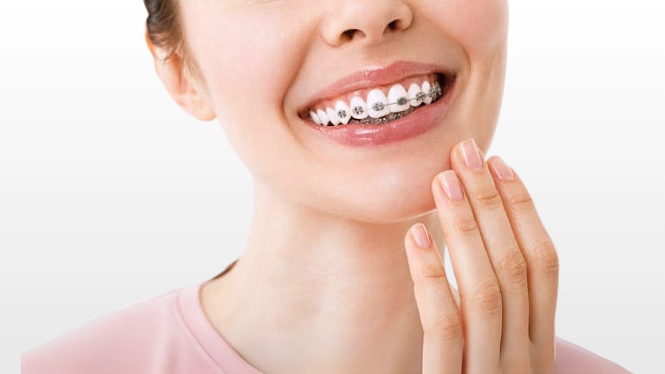 Teeth retainer service for a flawless smile