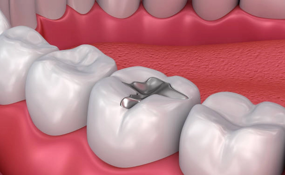 Advanced teeth filling treatment in Doha clinic.