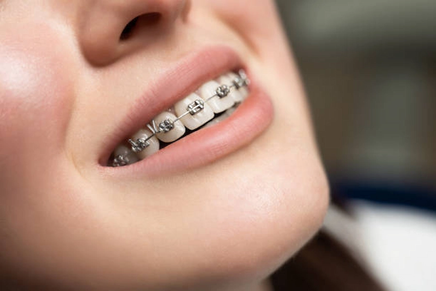 Orthodontic braces for a perfect smile