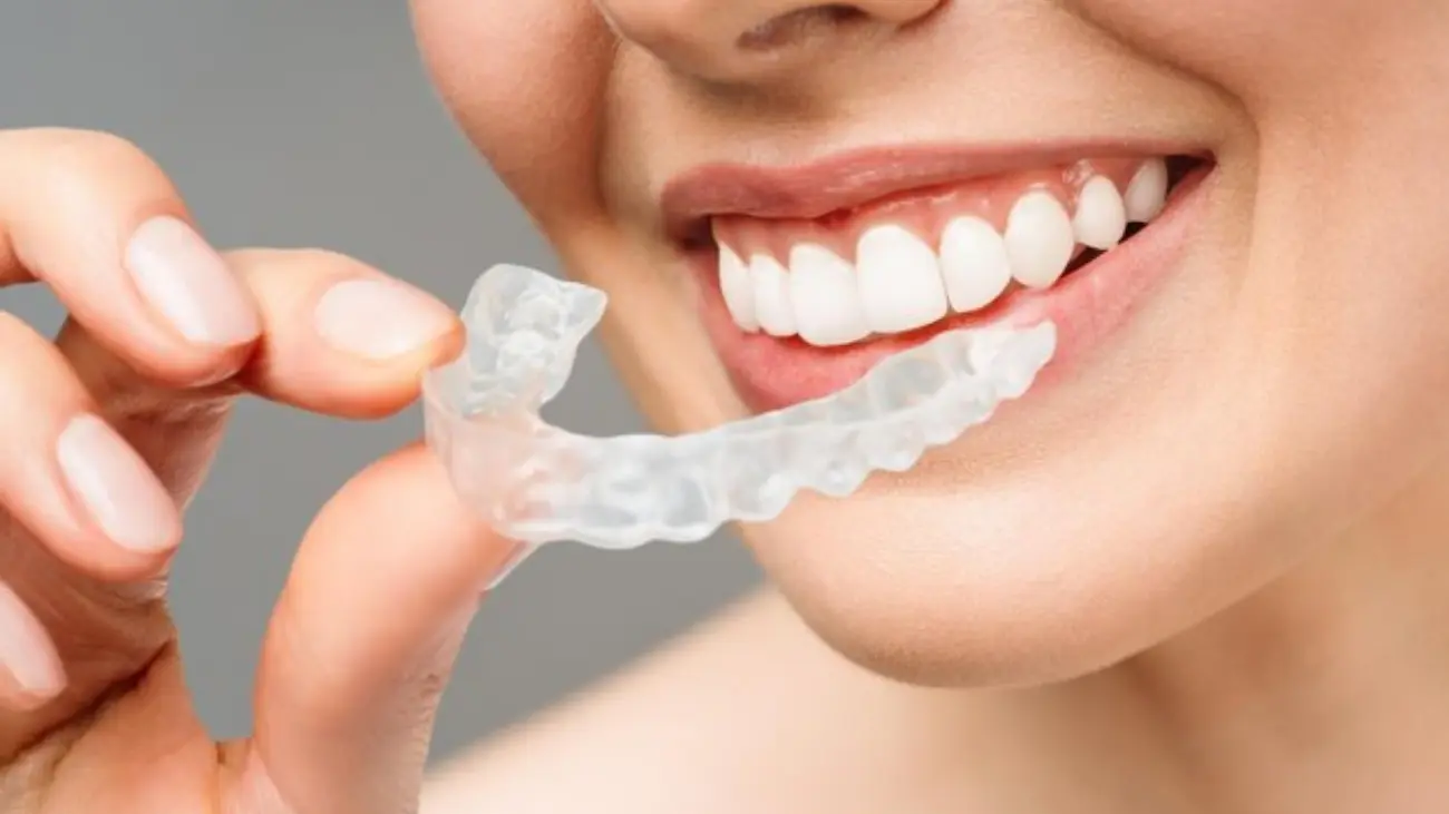 Aligners service for a perfect smile transformation