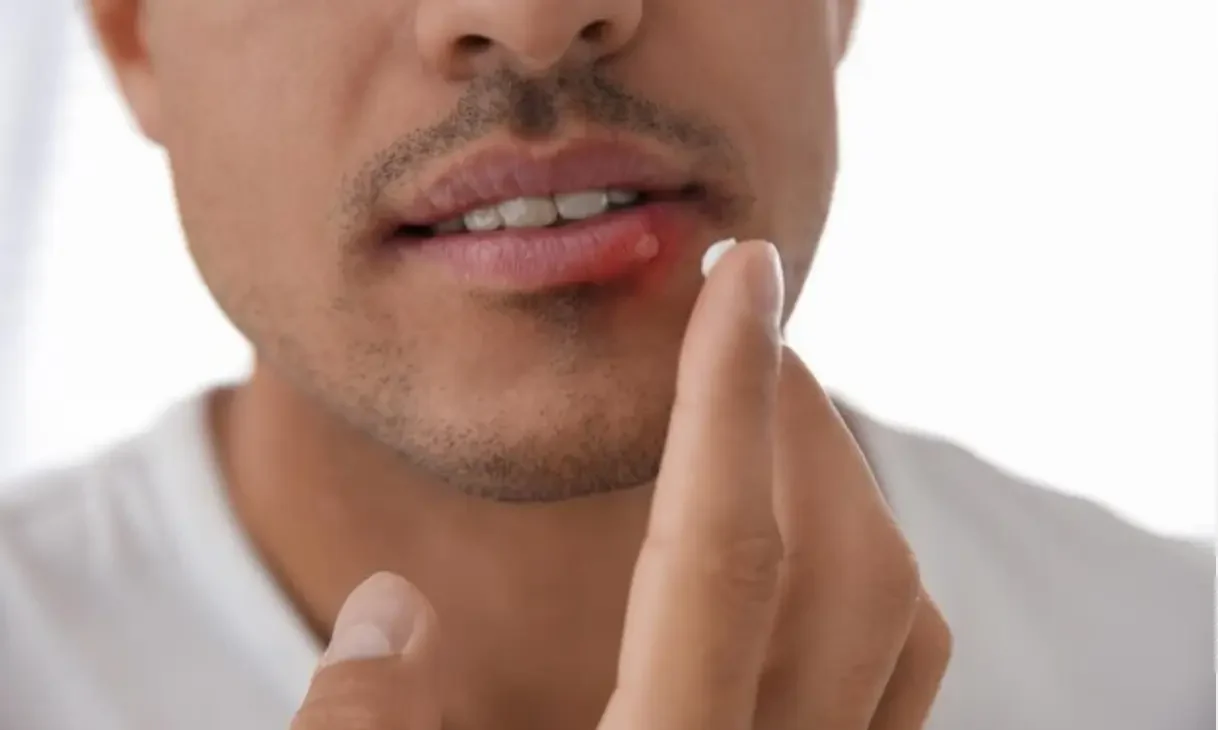 Effective canker sore treatment at ATOS Medical Center