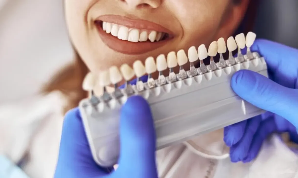 خدمات تركيب اسنان لتحسين الابتسامة والثقة