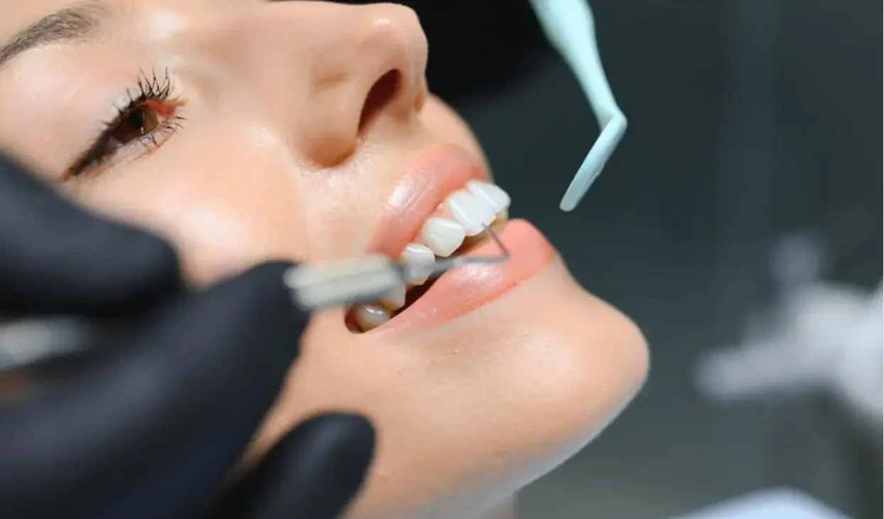 حشوات الأسنان التجميلية لتحسين الابتسامة والأناقة